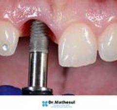 Dr Mathesul Invisalign Orthodontist Braces & Dental Implant Clinic in Kalyaninagar Pune